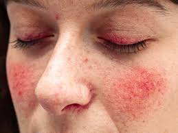 Rosacea