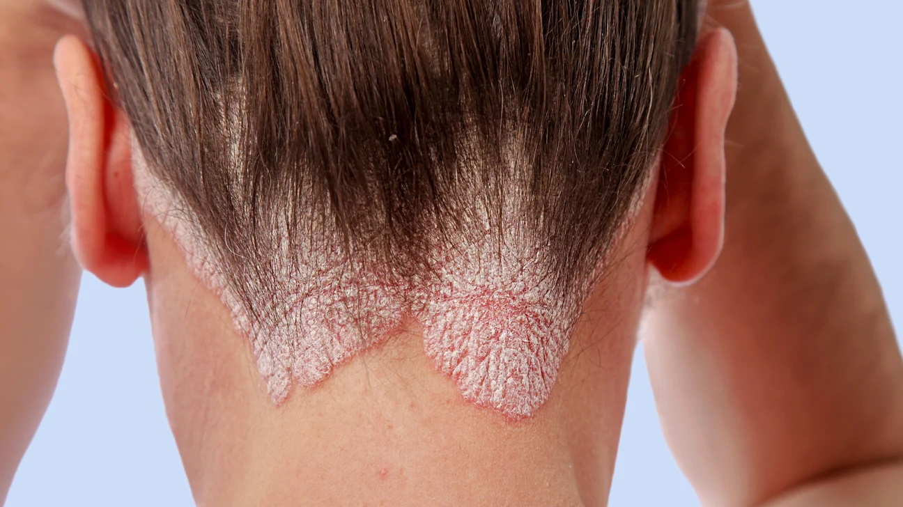 Scalp-psoriasis