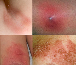 Skin Infections